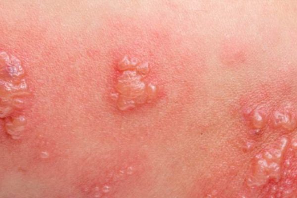 Як розпізнати оперізуючий лишай за висипом на шкірі