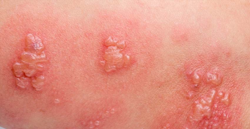 Як розпізнати оперізуючий лишай за висипом на шкірі