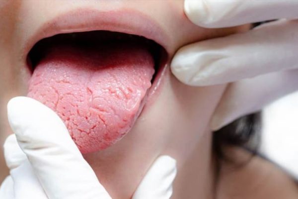 Як змінюється язик при цукровому діабеті та що це означає для здоров’я