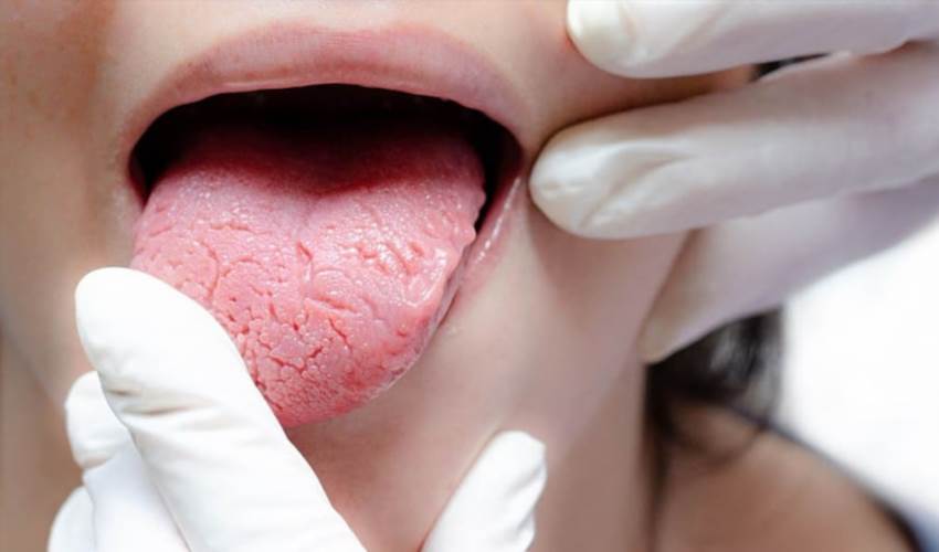 Як змінюється язик при цукровому діабеті та що це означає для здоров’я