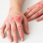 Як виглядає екзема на різних ділянках тіла та які бувають її види