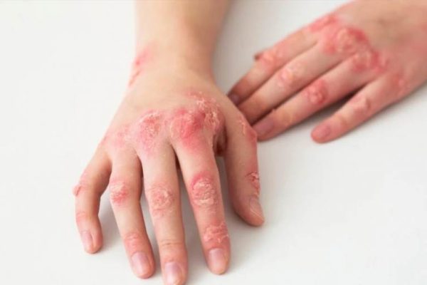 Як виглядає екзема на різних ділянках тіла та які бувають її види