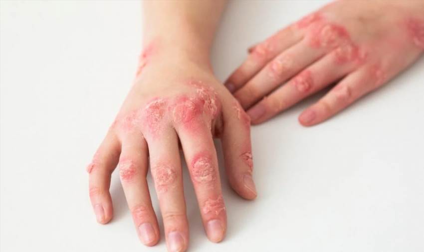 Як виглядає екзема на різних ділянках тіла та які бувають її види