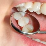 Скільки чекати до першого перекусу після пломби