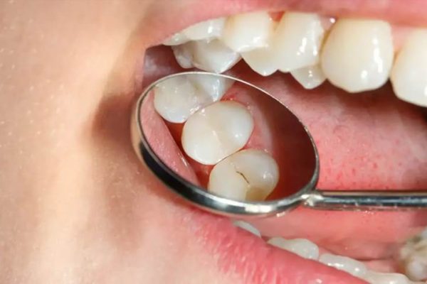 Скільки чекати до першого перекусу після пломби