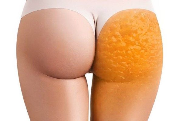 Як позбутися целюліту в домашніх умовах без дорогих процедур