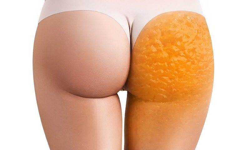 Як позбутися целюліту в домашніх умовах без дорогих процедур