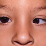 Косоокість - як виправити самостійно та коли потрібна операція