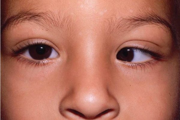 Косоокість - як виправити самостійно та коли потрібна операція