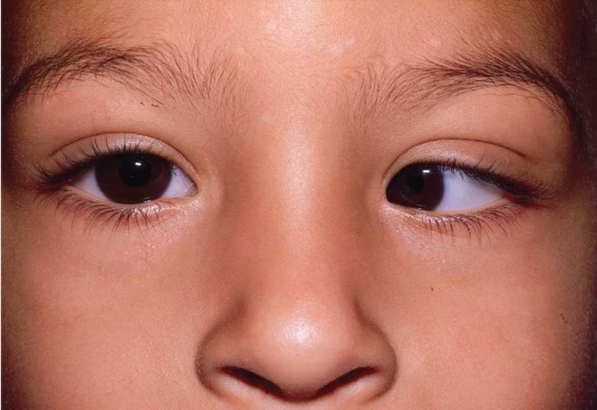 Косоокість - як виправити самостійно та коли потрібна операція