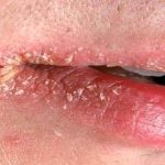 Як позбутися заїди за ніч без зайвих зусиль