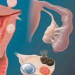 Коли матка має дві порожнини - що потрібно знати про дворогу матку