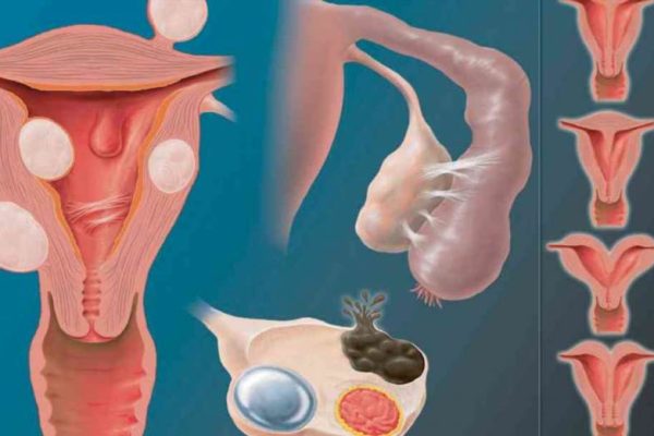 Коли матка має дві порожнини - що потрібно знати про дворогу матку