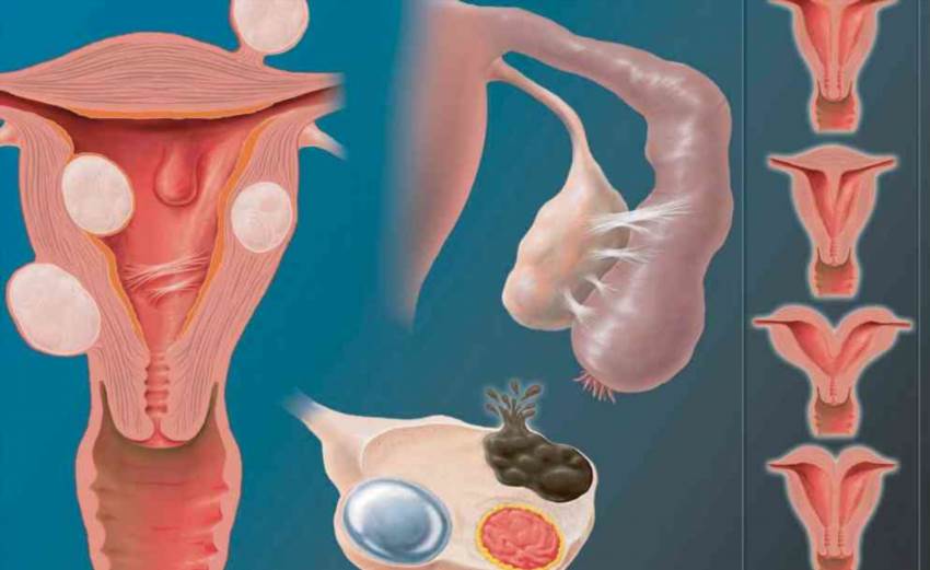 Коли матка має дві порожнини - що потрібно знати про дворогу матку