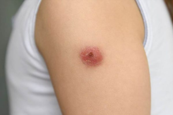 Карбункул коли гнійне запалення стає небезпечним