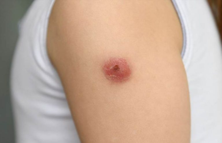 Карбункул коли гнійне запалення стає небезпечним