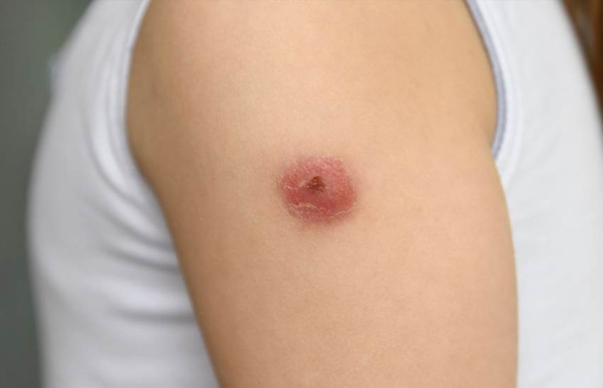 Карбункул коли гнійне запалення стає небезпечним