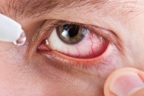 Як швидко прибрати почервоніння очей вдома ефективними методами