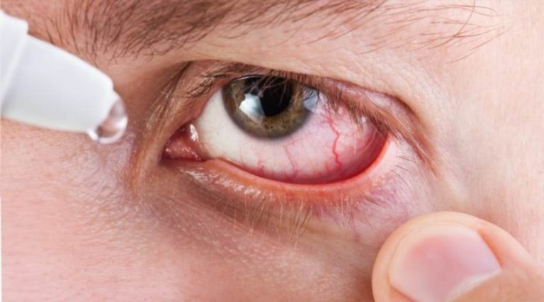 Як швидко прибрати почервоніння очей вдома ефективними методами